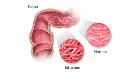 colitis