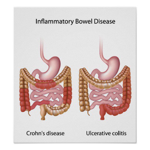 inflammatory-bowel-disease-ibd