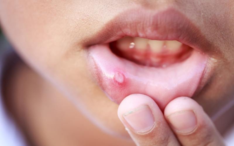 mouth-ulcer