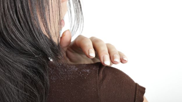 dandruff-home remedy