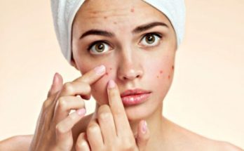 home remedies-for-Acne