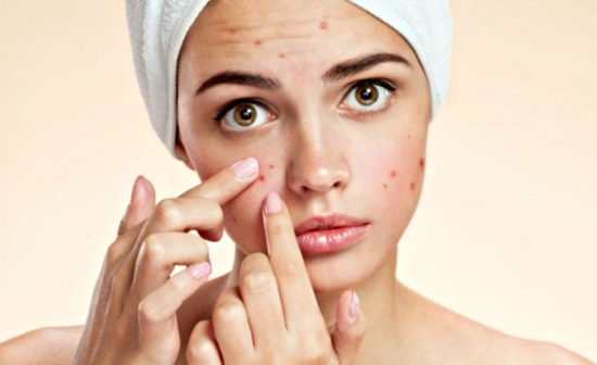 home remedies-for-Acne
